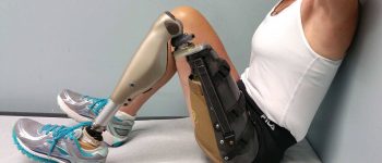 Diz Üstü Ayak Protezleri