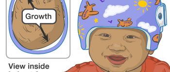 Pediatrik Özel Yapım Kraniyal Ortez (Kask)