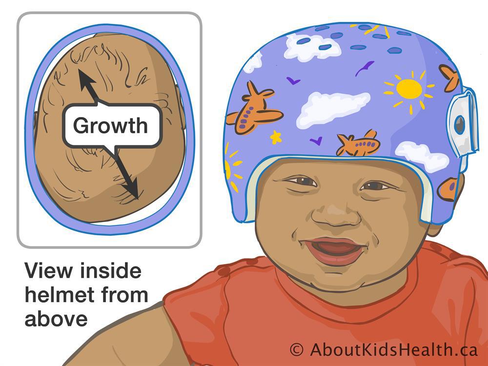 Pediatrik Özel Yapım Kraniyal Ortez (Kask)